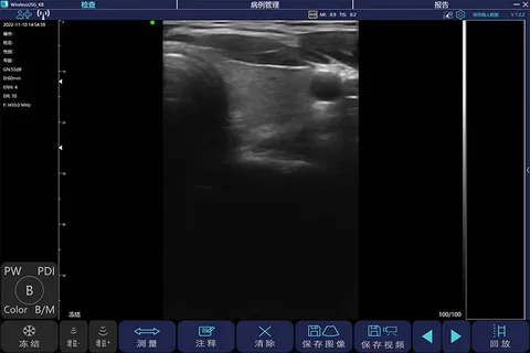 C100T浅表线阵灰阶超声图像,甲状腺与颈部浅表组织显示