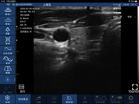 6F血管横断面灰阶超声图像