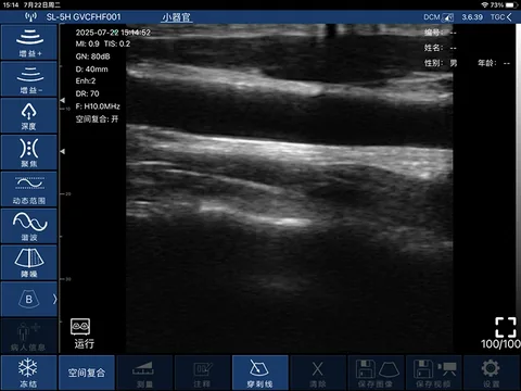 6F血管长轴灰阶超声图像