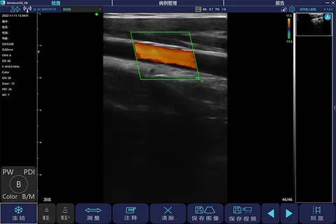 C100T线阵彩色多普勒超声图像,肌肉内血管彩色血流束显示