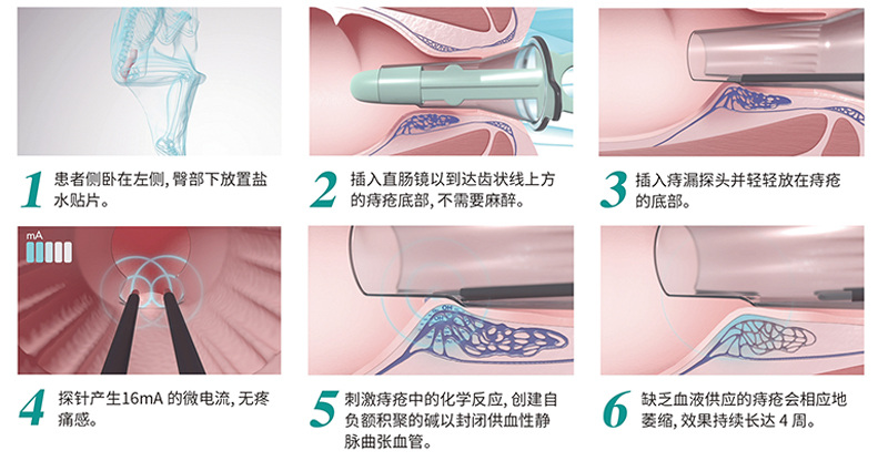 E8_07_参数图 E8 痔疮电解治疗仪参数图 07