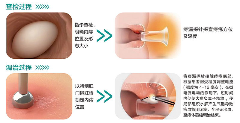 E8_06_参数图 E8 痔疮电解治疗仪参数图 06
